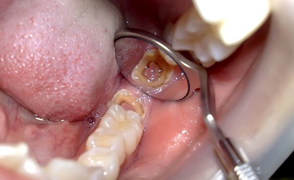 Tác Hại Của Việc Không Nhổ Răng Sâu?