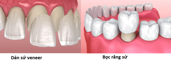 Nên Dán Răng Sứ Hay Bọc Răng Sứ?
